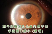 現代白內障手術更安全舒適
