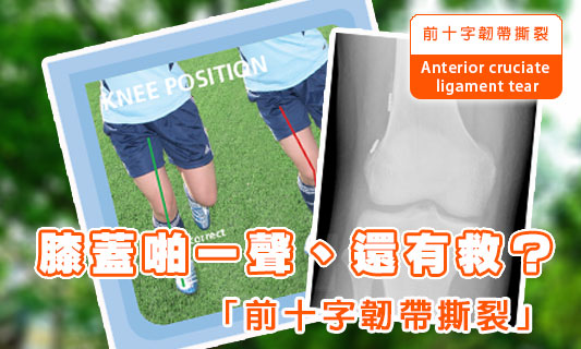 膝蓋啪一聲、還有救？
「前十字韌帶撕裂」