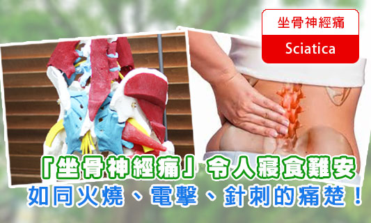 患「坐骨神經痛」令人寢食難安
如同火燒、電擊、針刺的痛楚！