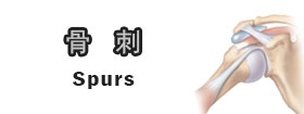 骨刺Spurs