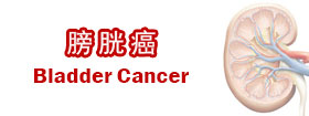 膀胱癌 - Bladder Cancer
