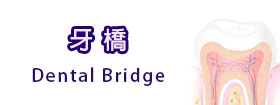 牙橋[Dental Bridge]
