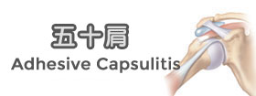 五十肩[Adhesive Capsulitis]