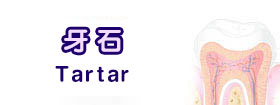 牙石[Tartar]