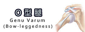 O型腿Bow-leggedness