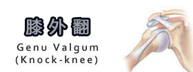 膝外翻Knock-knee